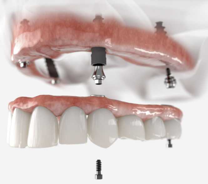 all on 4 dental implants victoria