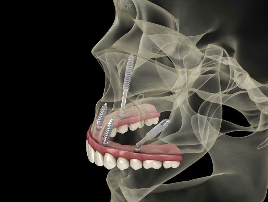 zygomatic pterygoid dental implants london victoria