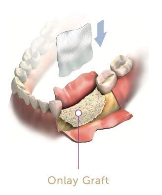 sinus and bone grafting