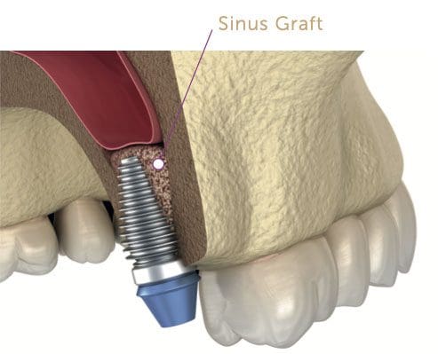 sinus and bone grafting 1