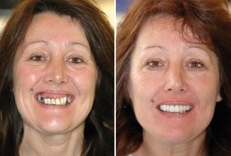 Lady Smiling after Full Mouth Implants Before and After