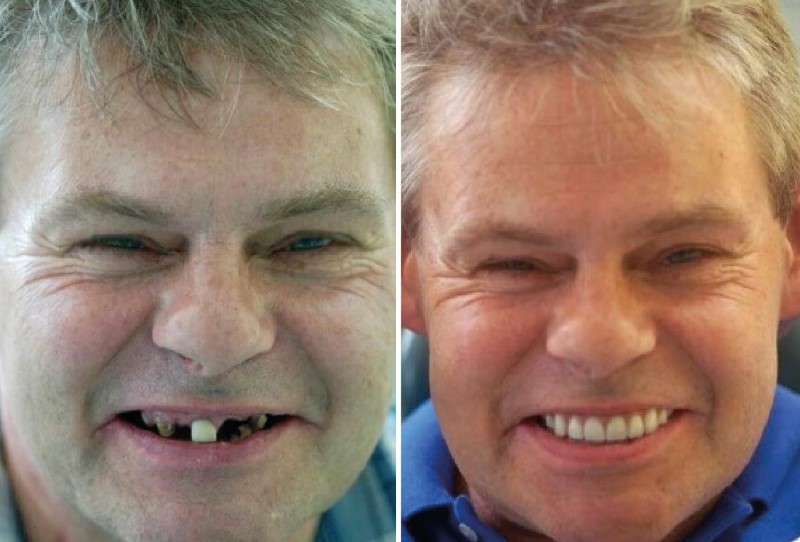 Man Smiling after Full Mouth Implants Before and After